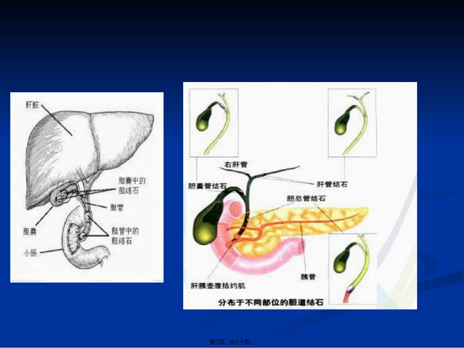 中国慢性胆囊炎、胆囊结石社区诊疗_第3页