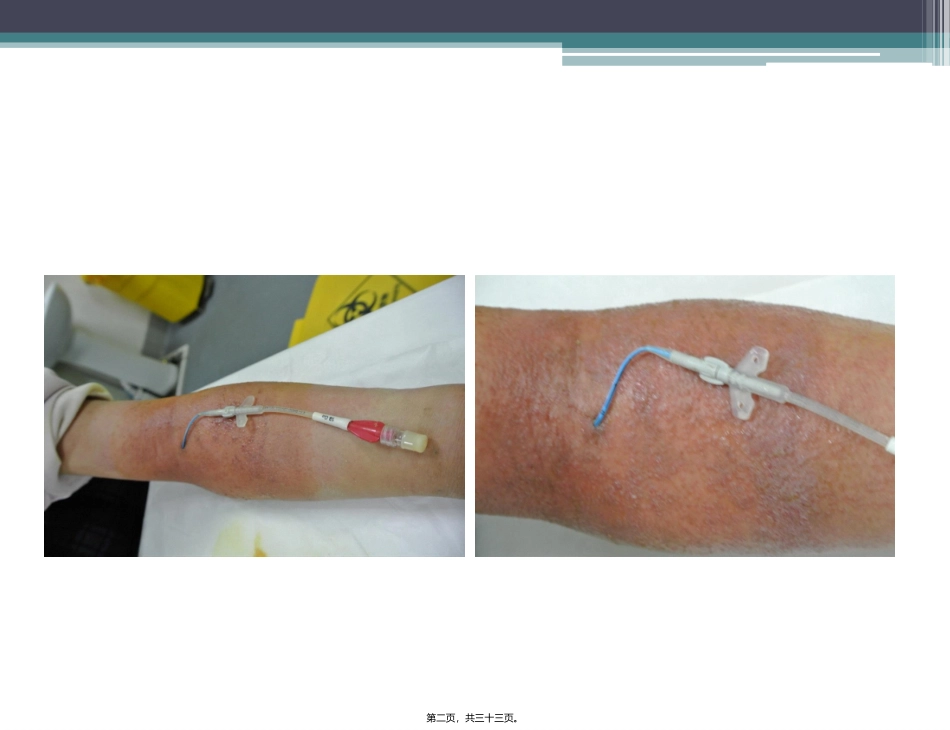 严重的接触性皮炎的处理..精讲_第2页