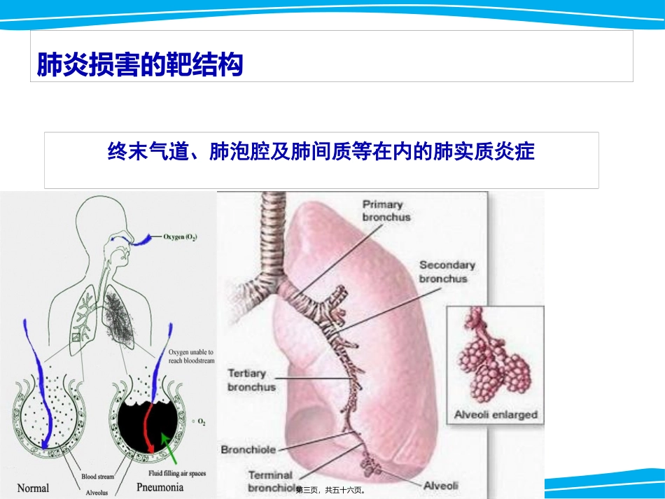 严重肺部感染诊治策略_第3页