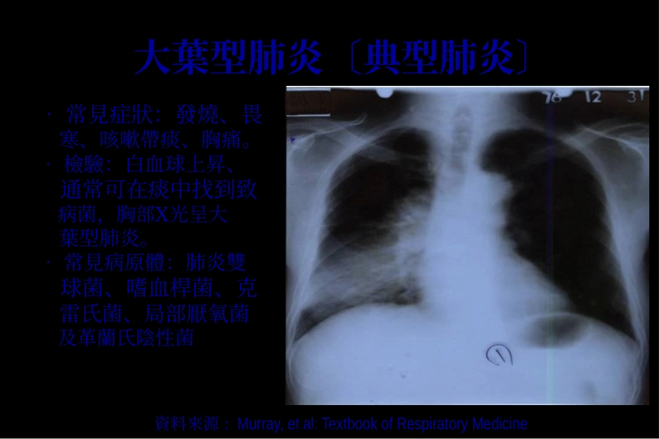 严重急性呼吸道症候群_第2页