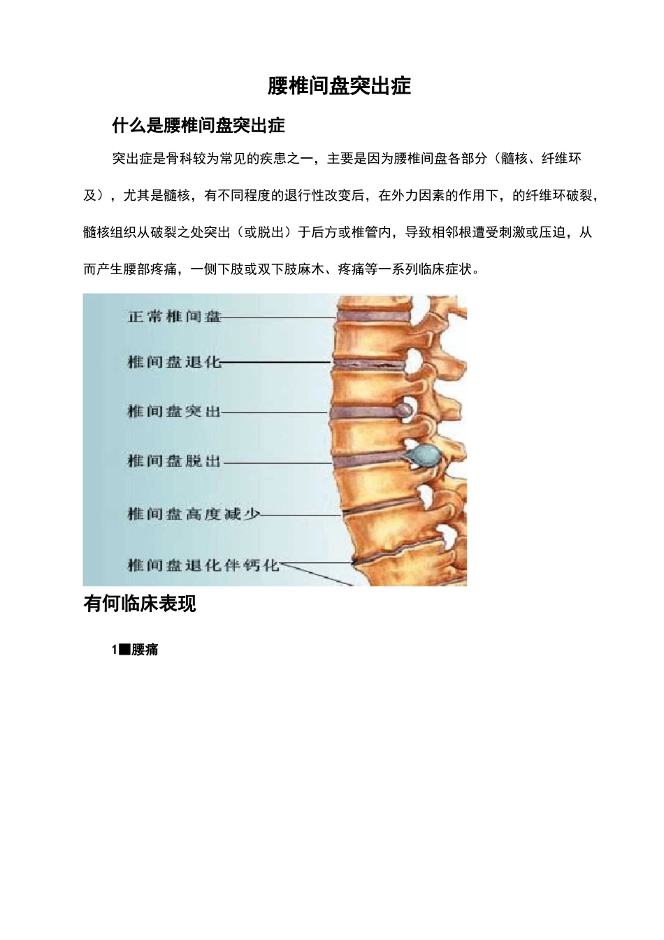 腰椎间盘突出症科普_第2页