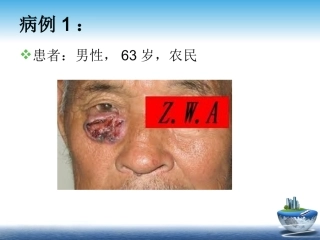 眼睑基底细胞癌