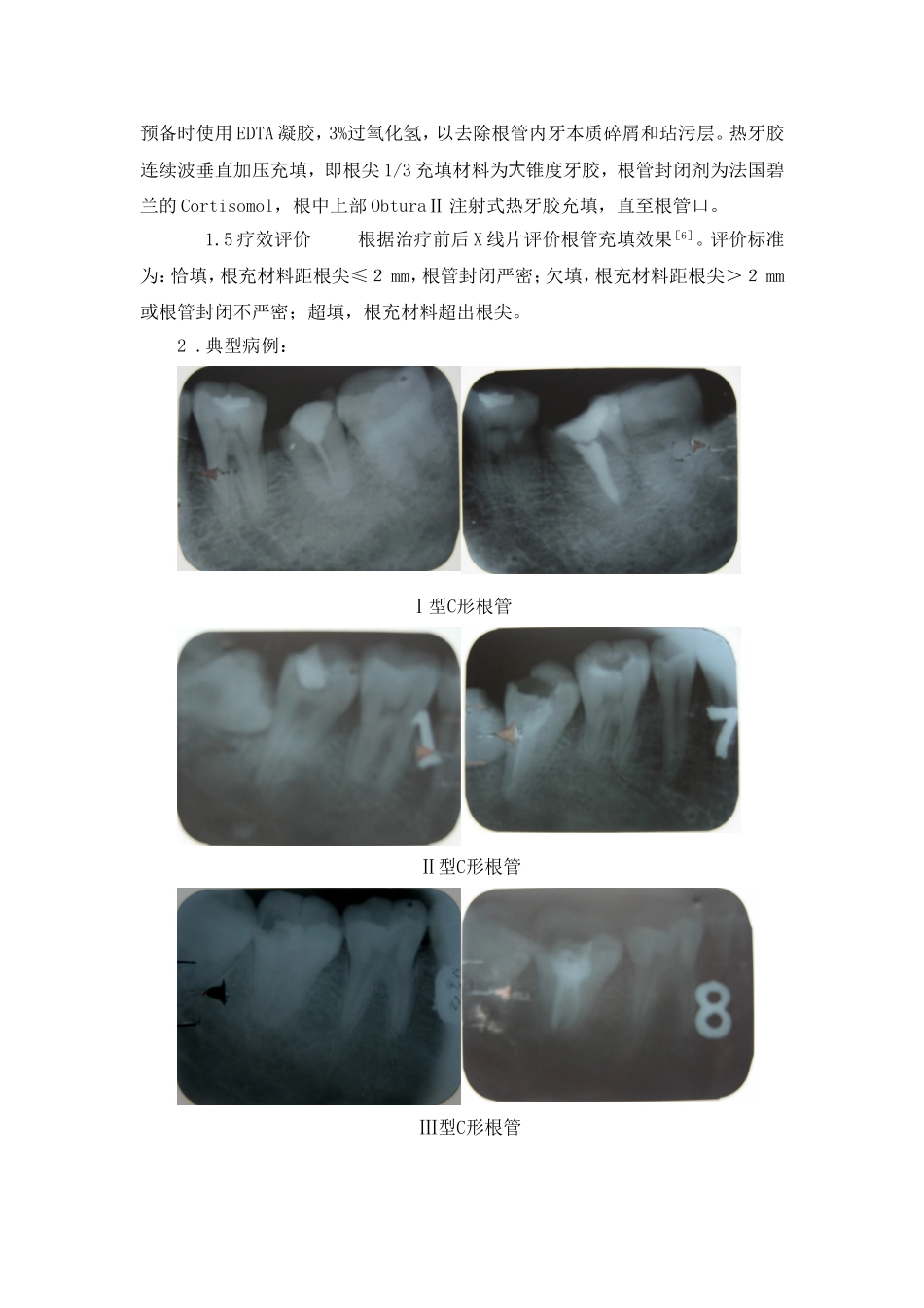 c形根管的诊断与治疗_第2页