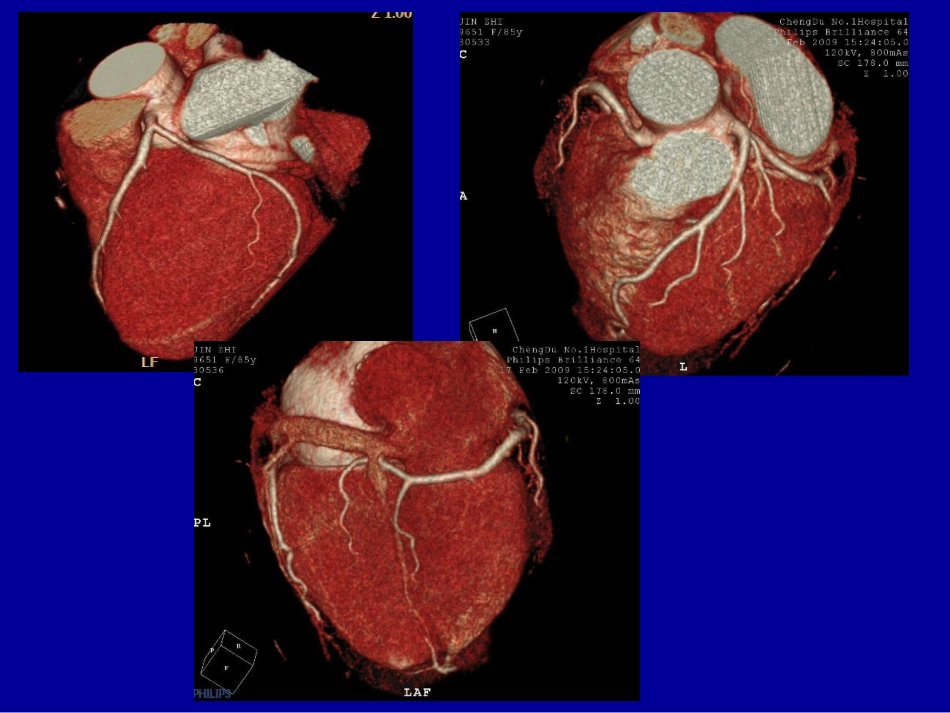 冠状动脉CTA成像_第3页