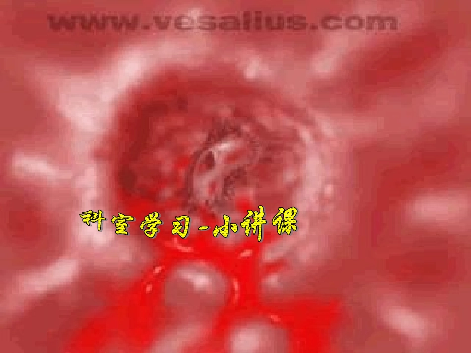 上消化道大量出血-09-李晓玲_第1页