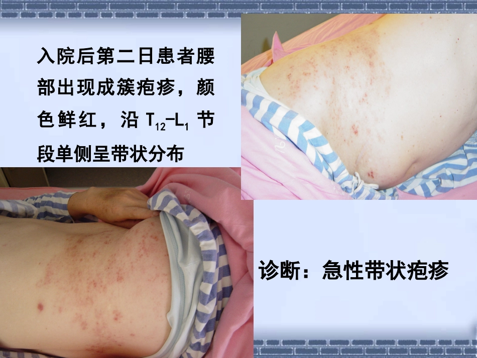 带状疱疹诊治_第3页