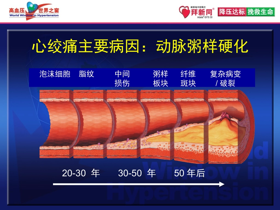 中国稳定性心绞痛指南带来的启示+解说词-final_第3页