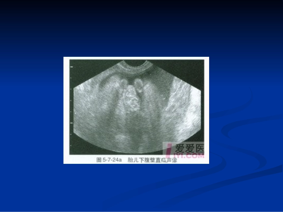 胎儿骨骼系统发育异常的超声诊断_第3页