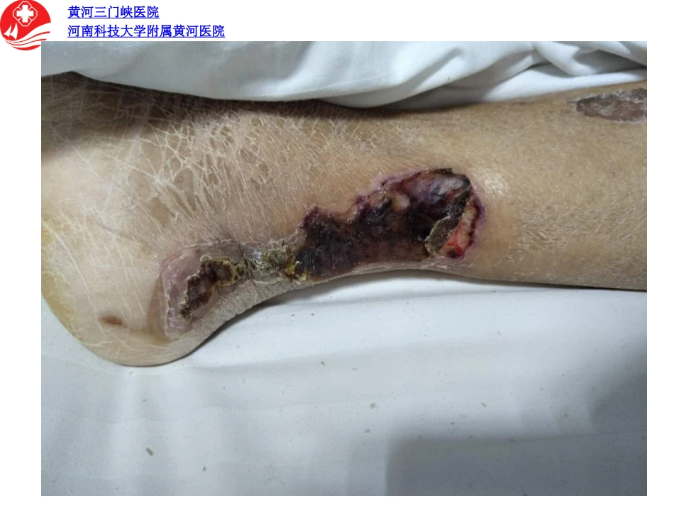 慢性伤口病例分享ppt_第3页