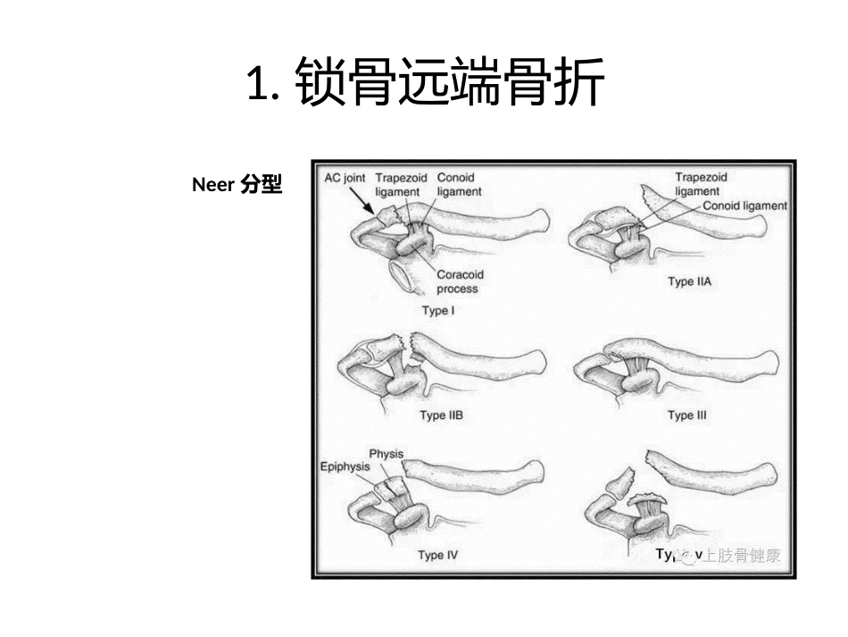 上肢骨折分型_第2页