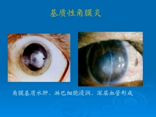 基质性角膜炎