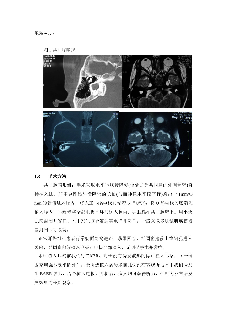 共同腔畸形患者人工耳蜗植入疗效评估2_第3页