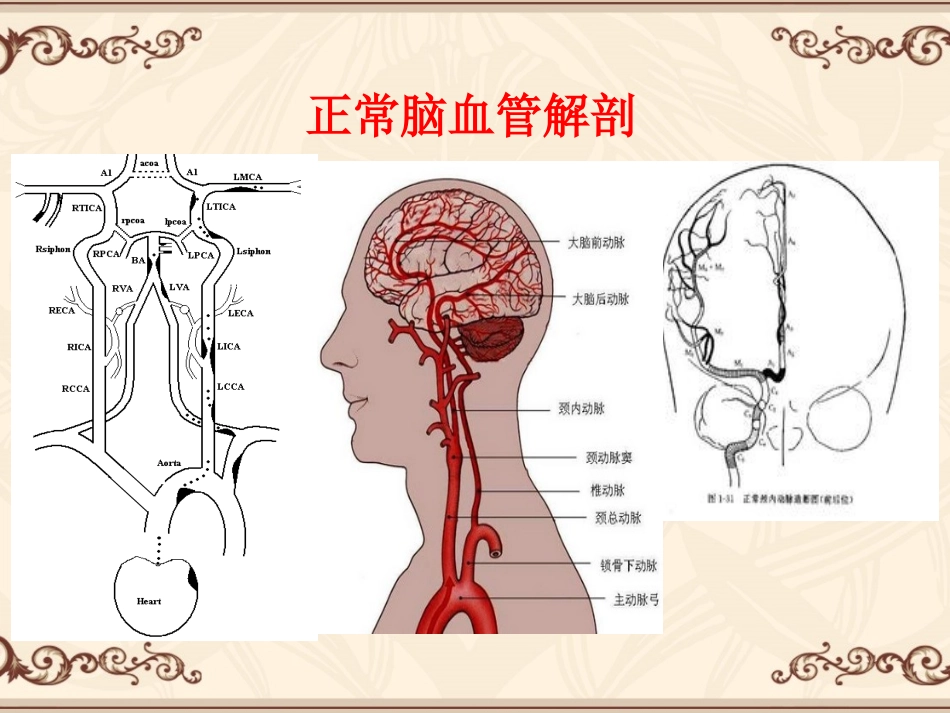 如何正确认识脑梗塞.._第3页
