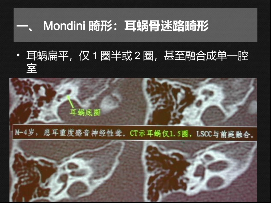 内耳畸形CT表现_第3页