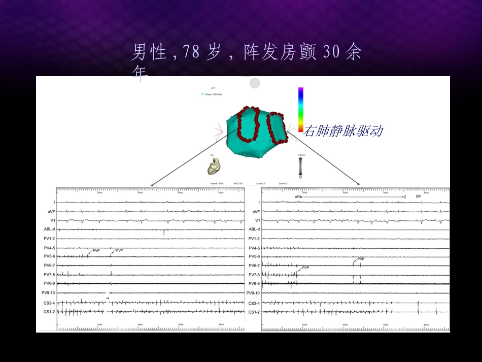 房颤导管消融的适应症_第2页