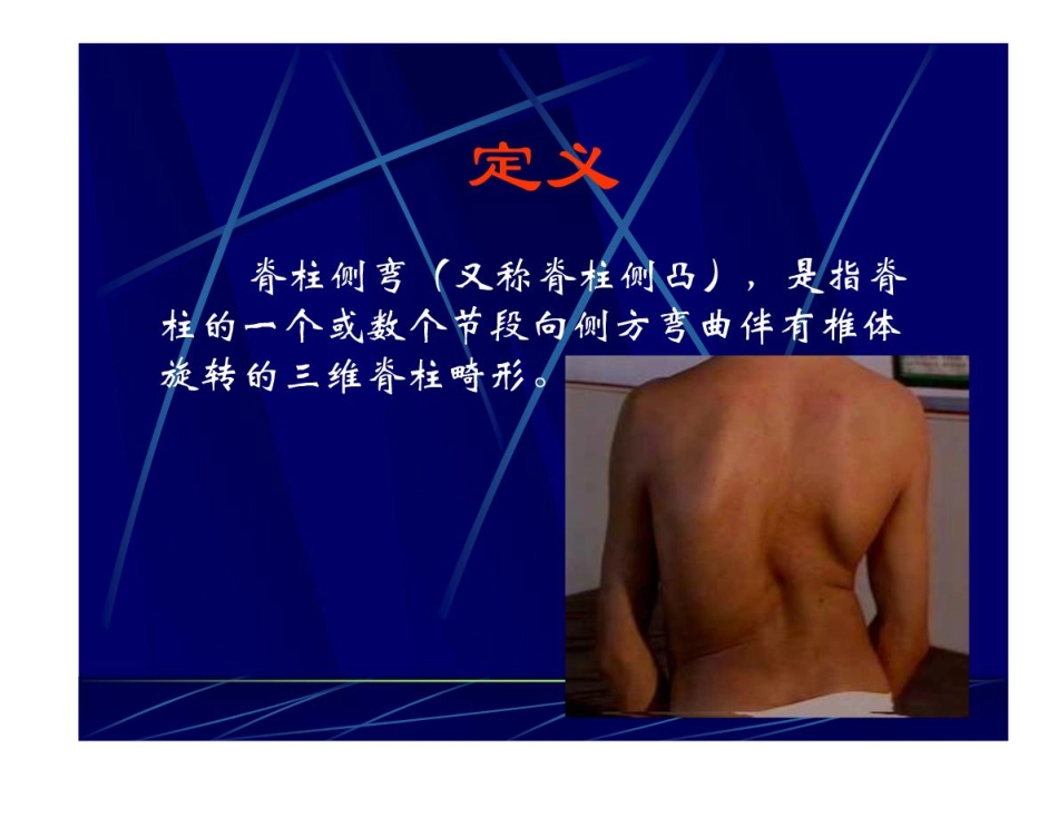 特发性脊柱侧弯评定及康复治疗_第2页