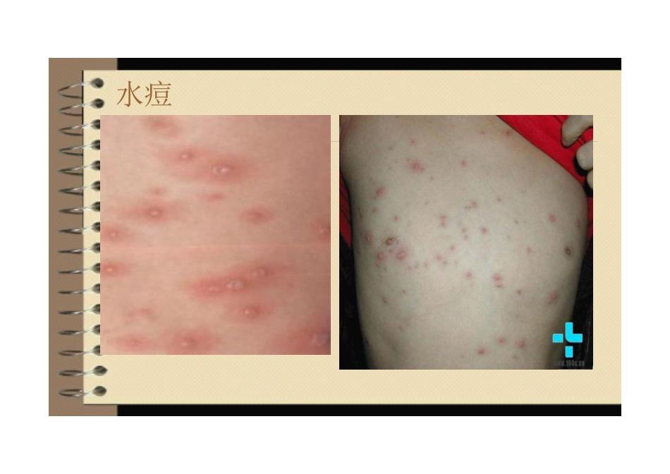儿科出疹性疾病_第3页