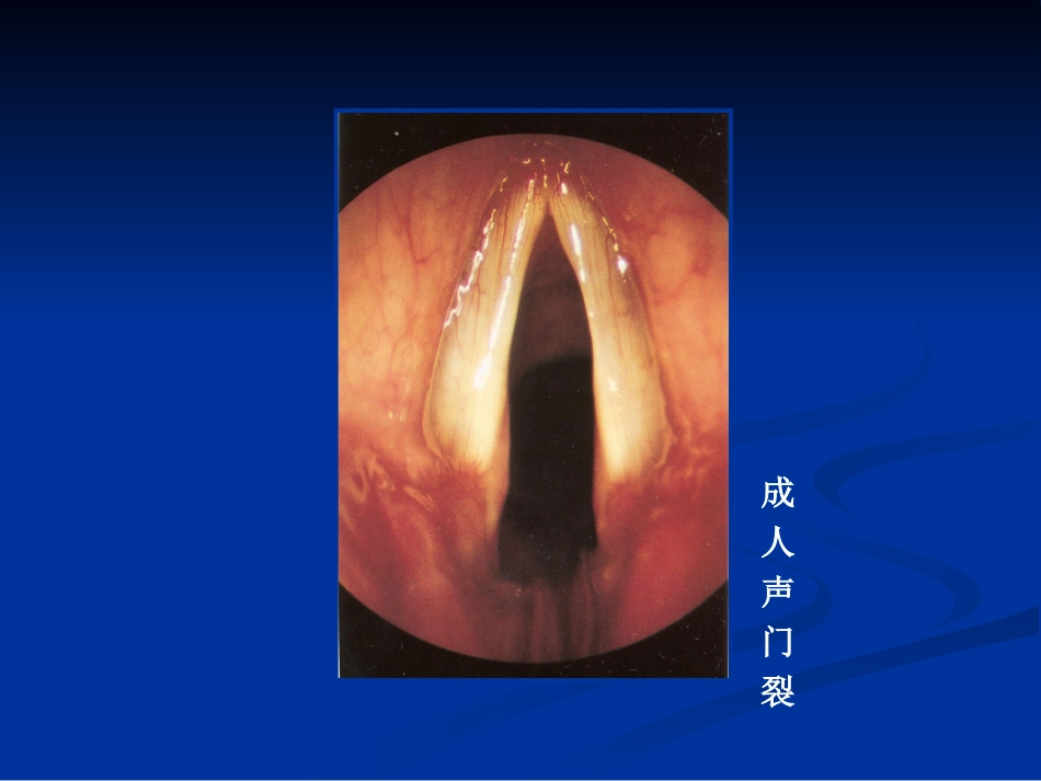 间接喉镜检查_第3页