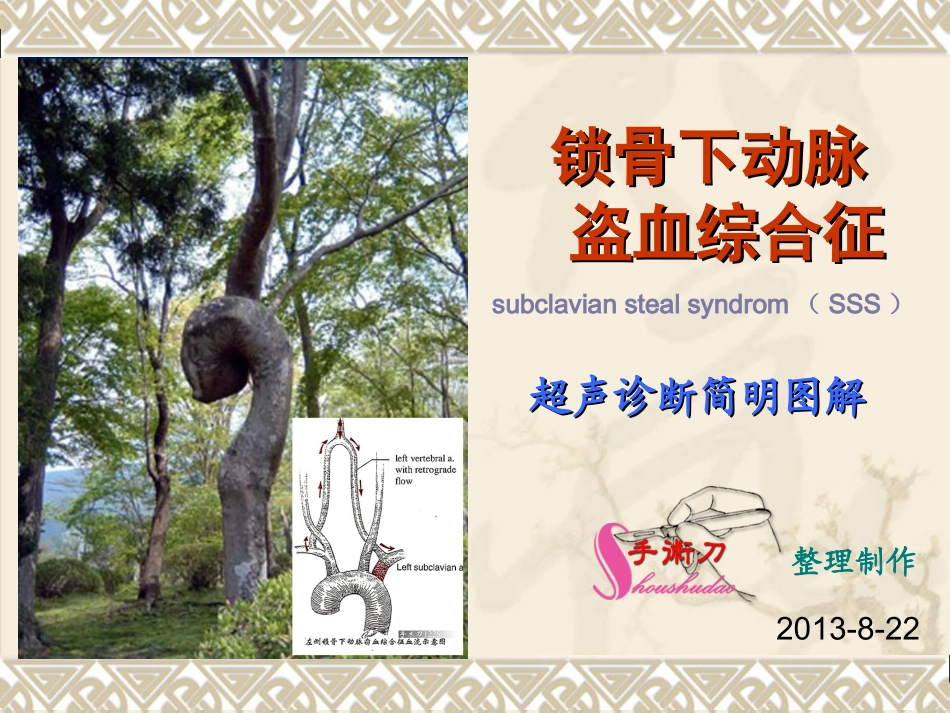锁骨下动脉盗血综合症图解_第1页