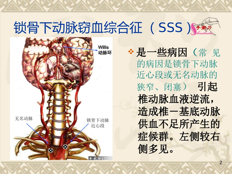 锁骨下动脉盗血综合症图解_第2页