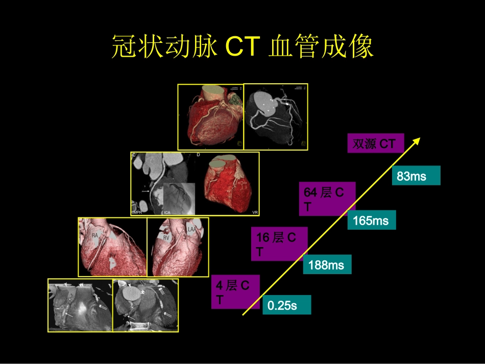 多排螺旋CT在冠状动脉成像中的应用_第3页