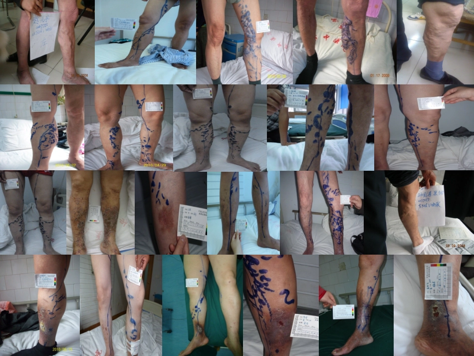 下肢静脉曲张.ppt_第2页