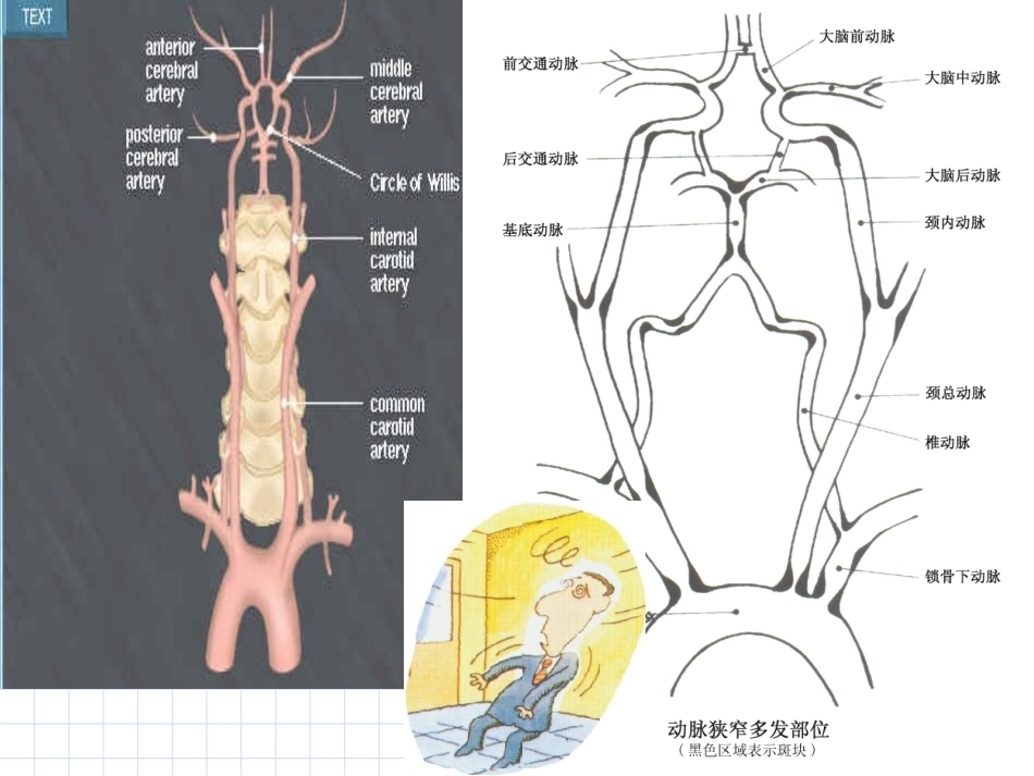 后循环缺血专家共识(2006年)_第3页