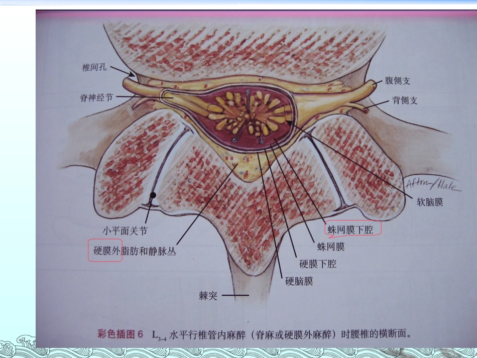 第十一章___椎管内麻醉及护理_第3页