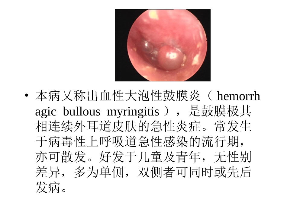 大泡性鼓膜炎_第3页