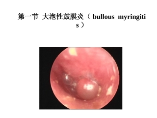 大泡性鼓膜炎