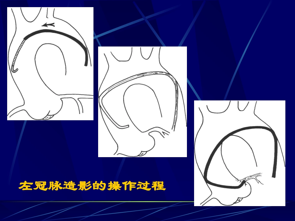 爱爱医资源-冠脉造影术简装板-绝好资料_第2页