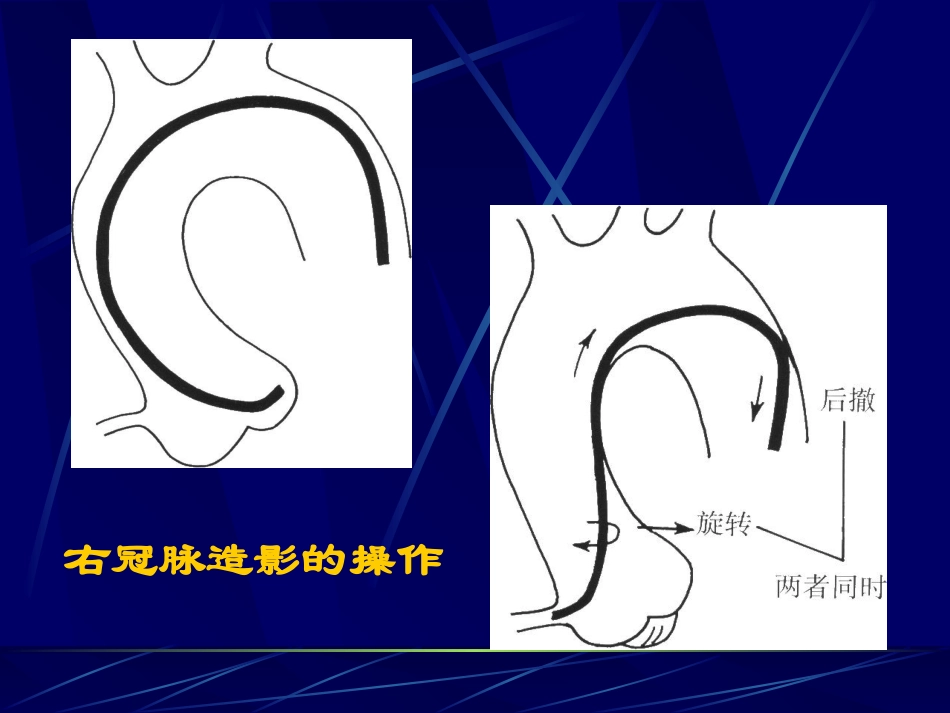 爱爱医资源-冠脉造影术简装板-绝好资料_第3页