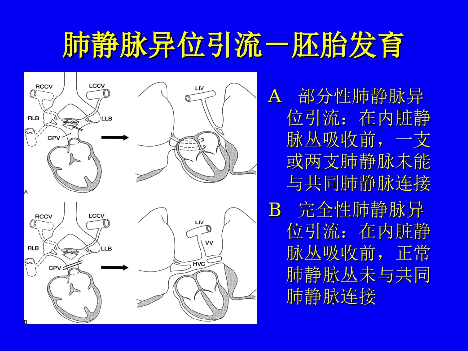 肺静脉异位引流_第3页