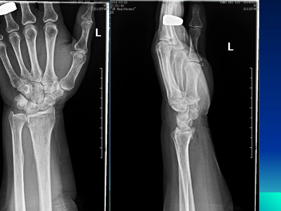 容易遗漏骨折.整理_第2页