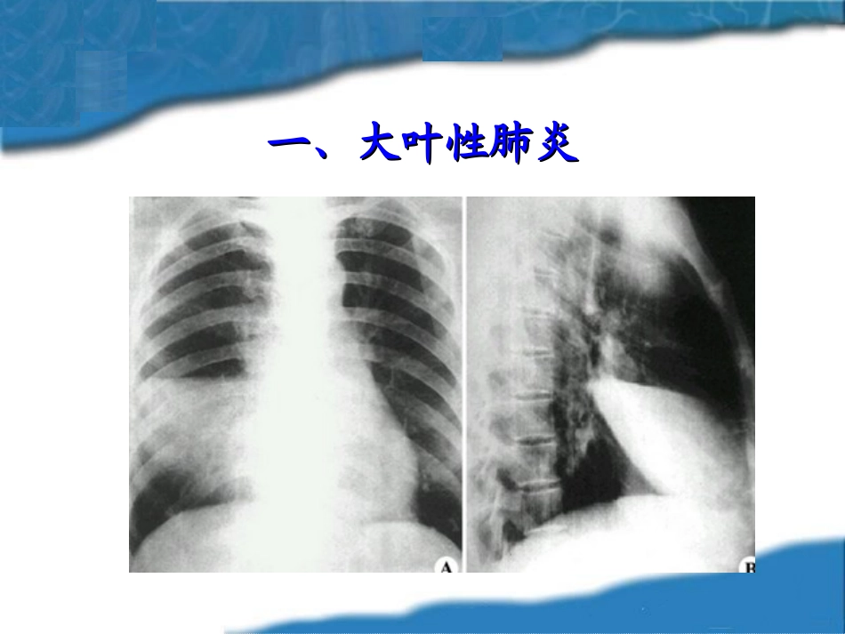 呼吸系统常见症状体征._第3页