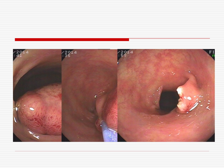 大肠癌普查与随访_第3页