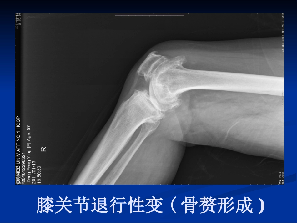 膝关节骨性关节炎介绍_第3页