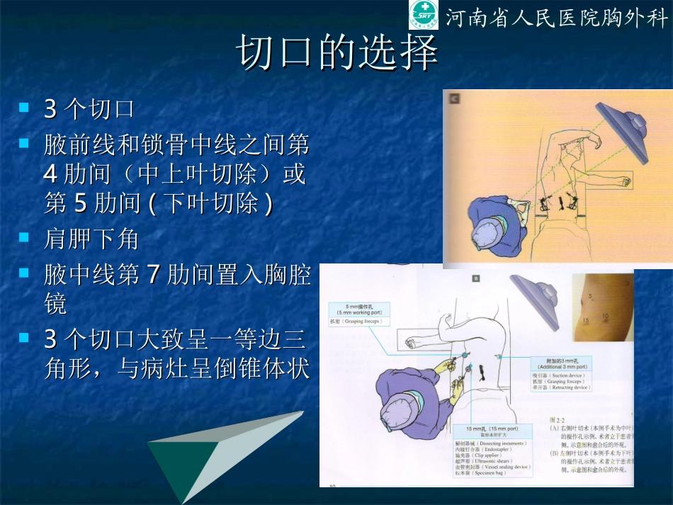 VATS肺叶切除_第2页