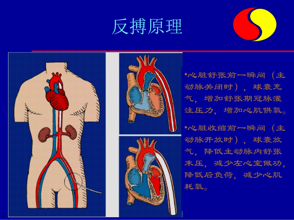 主动脉气囊反搏_第3页