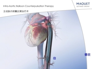 主动脉内球囊反搏术1