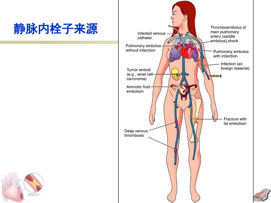 局部血液循环障碍-栓塞与梗死_第3页