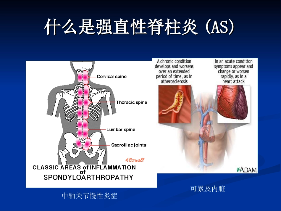 强直性脊柱炎及其伴发的葡萄膜炎_第2页