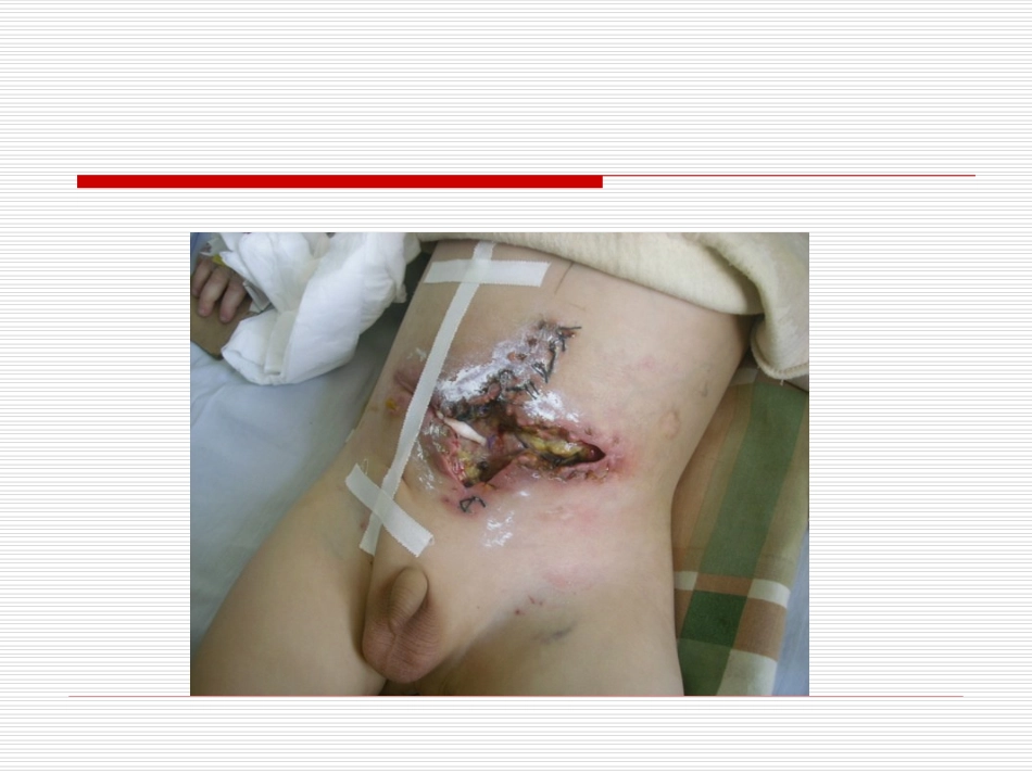 第七章_外科感染病人的护理.ppt1_第2页