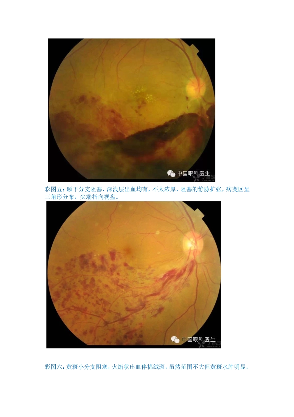 看图片病例学视网膜分支静脉阻塞_第3页