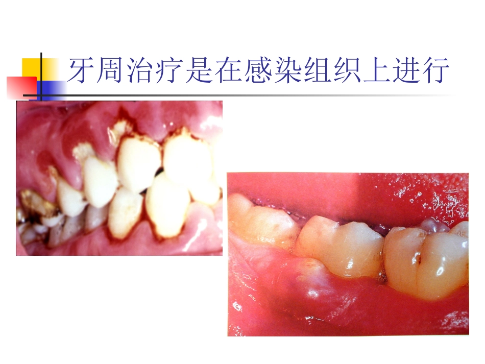 全身疾病患者的牙周治疗特点_第3页