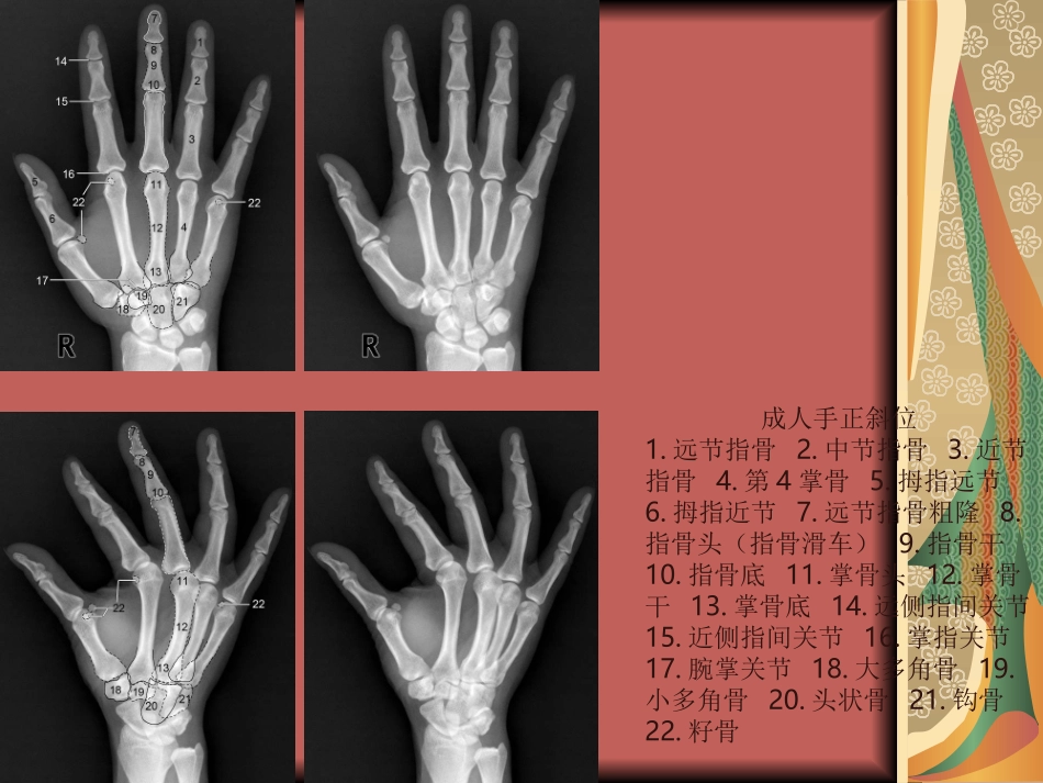 四肢关节正常变异、常见病变及创伤的影像表现_第3页