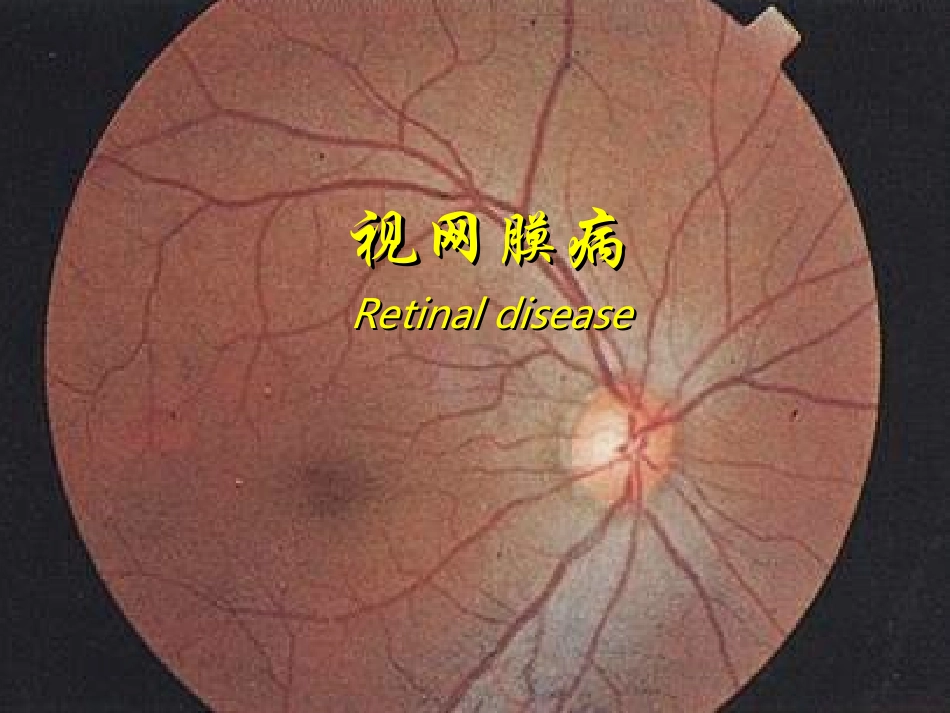视网膜病图谱_第1页