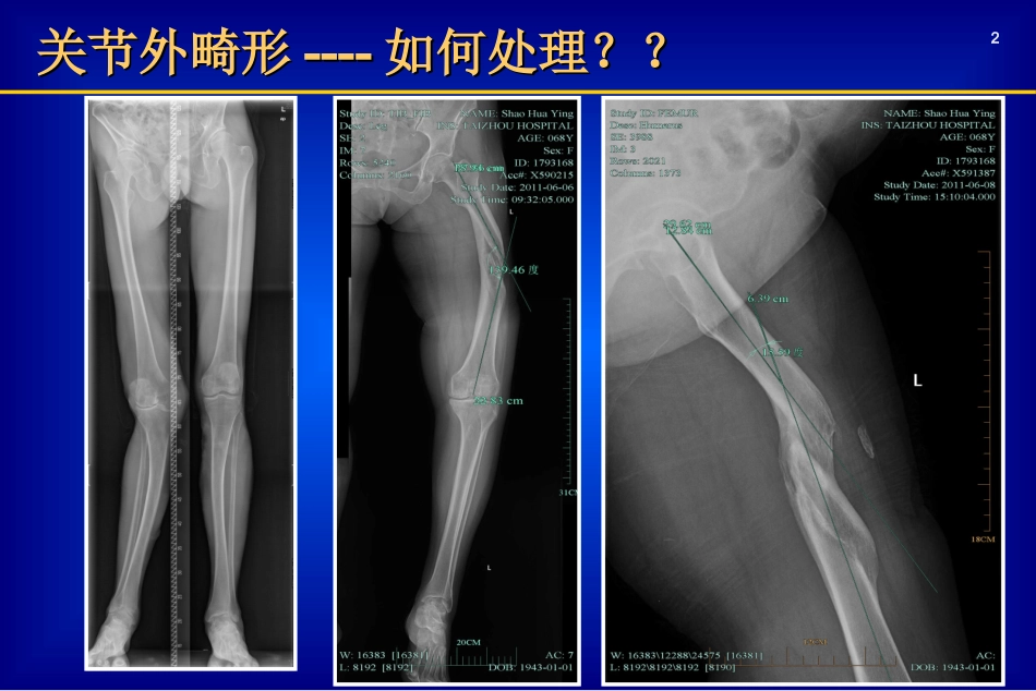 关节外畸形全膝_第2页