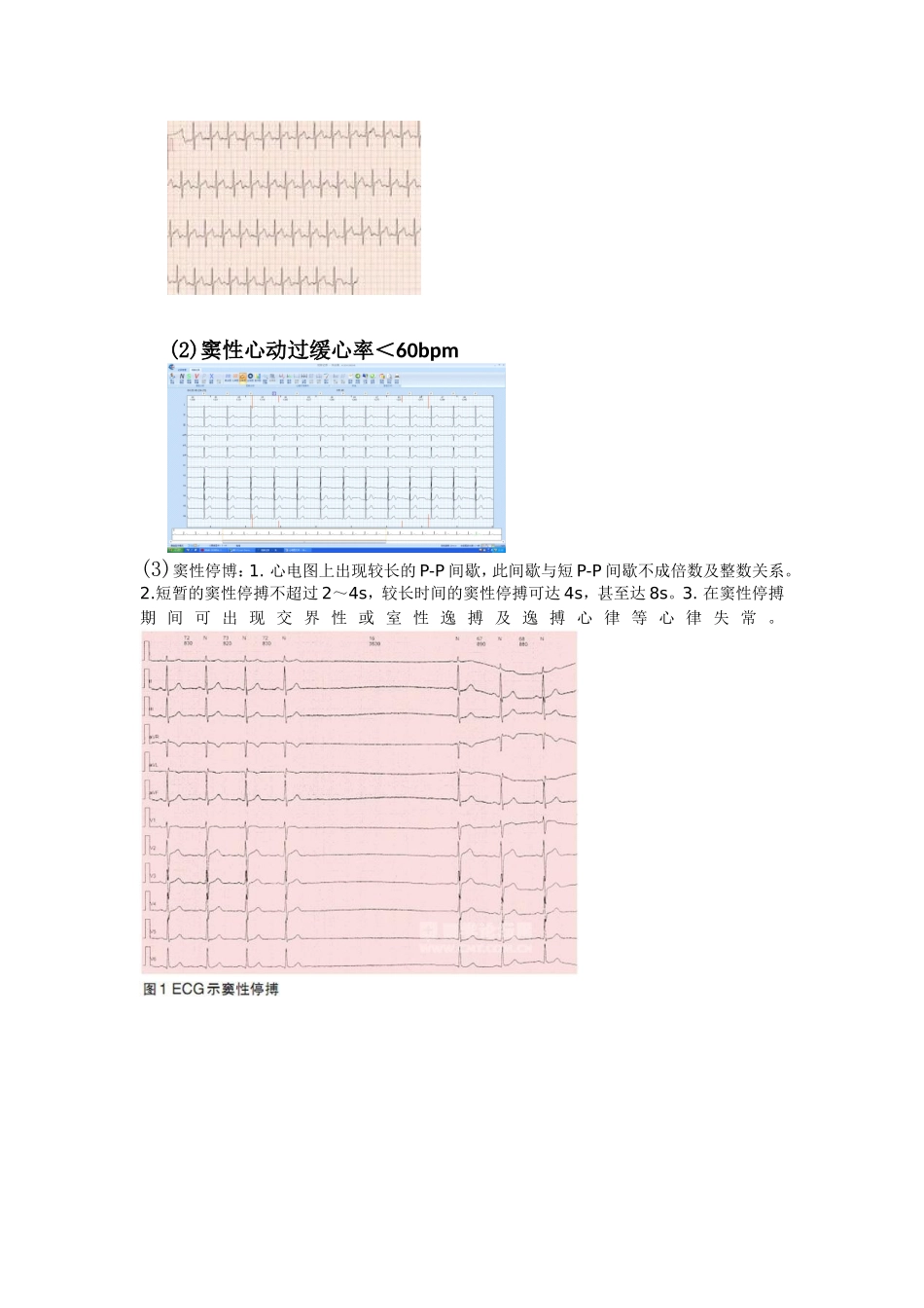 常见心律失常的心电图阅读_第2页