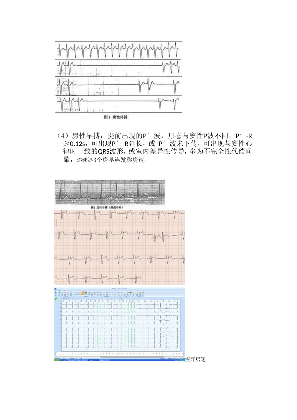 常见心律失常的心电图阅读_第3页